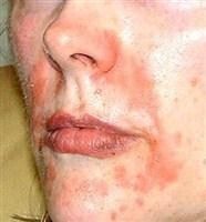 Best Acne Blackhead Spot Blemish Treatment Spray ANT50