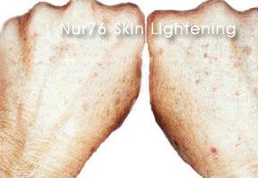 NUR76 Skin Lightening Cream Whitening Serum Face Acne
