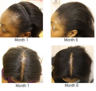  Potent Jamaican Black Castor Oil for Traction Alopecia 8oz