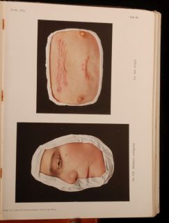 1918 2V Atlas Der Hautkrankheiten Jacobi Skin Disease
